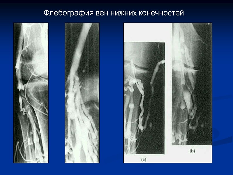 Флебография вен нижних конечностей.